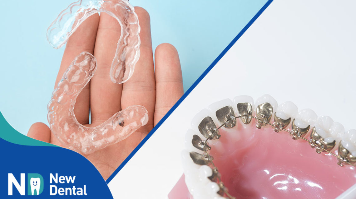 Ortodonzia linguale o invisalign? Le principali differenze